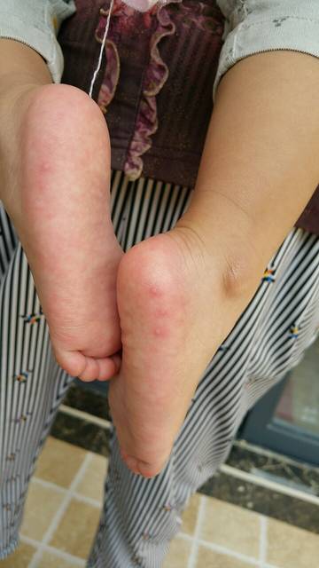 姐妹们 注意了口腔疱疹和手足口病