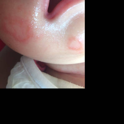 宝宝脸上出现红色的斑块,第二天中间有白色慢