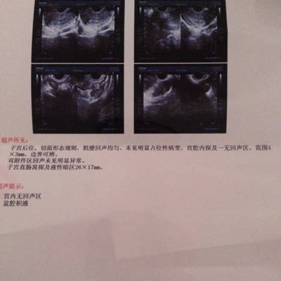 初孕5周,腹部右侧有点阵痛,盆腔积液26×17m