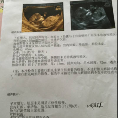29岁,第1胎,12周,做nt结果显示宫腔内可见条状液性暗区,范围约52*10mm