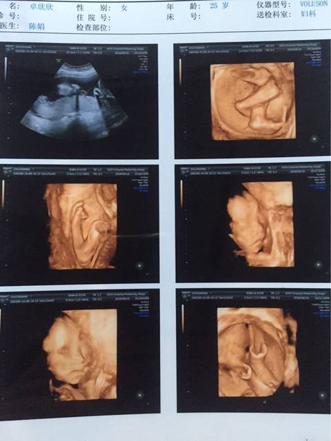 昨天照了四维,单卵双胎大伙猜猜看男女_昨天照