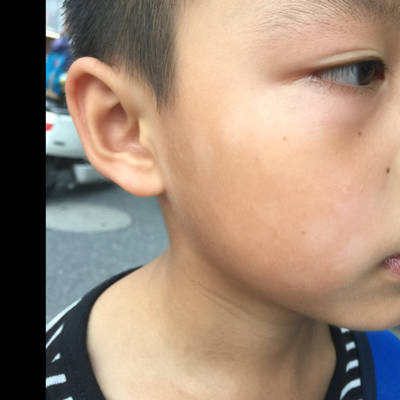 8岁小孩夏天脸上除了很多白斑,孩子本身也有点湿疹,冬天脸上1-2处斑点