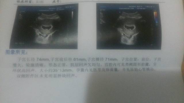 妈们快来接健康胎心胎芽了。_怀孕45天B超只