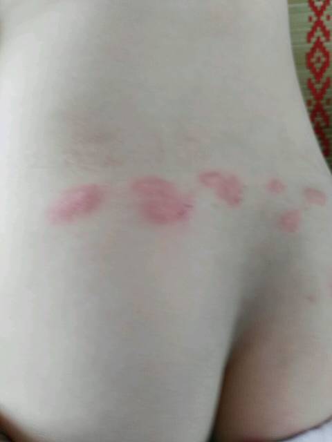 丘疹性荨麻疹,吃点啥药好的快_孩子睡中午觉起