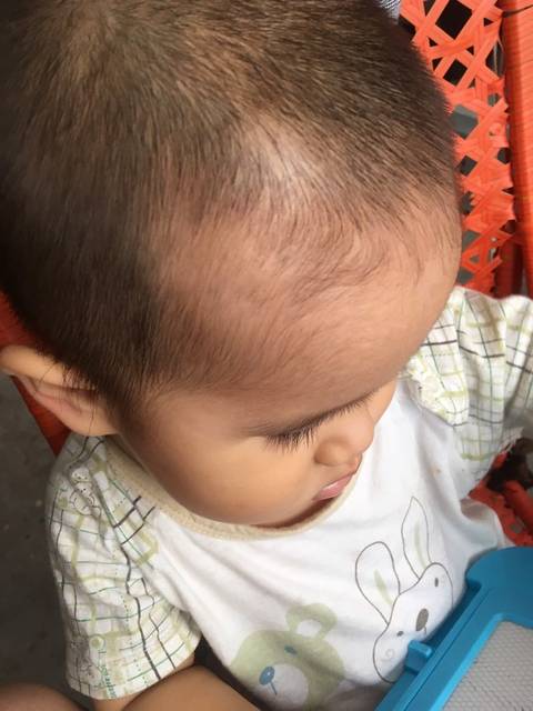 宝宝头上有一个白色的不长头发这是什么啊