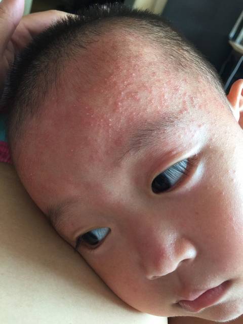 求解_有没有宝妈知道孩子这是热痱子还是过敏?_宝宝树