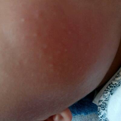 宝宝脸上起了白色的小米粒疙瘩最近胳膊上也有了好几个月了