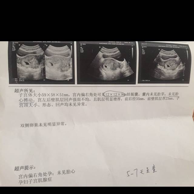 有没有宫内偏右处孕_孕4周6天，突然像月经一样的出血，然后B_宝宝树