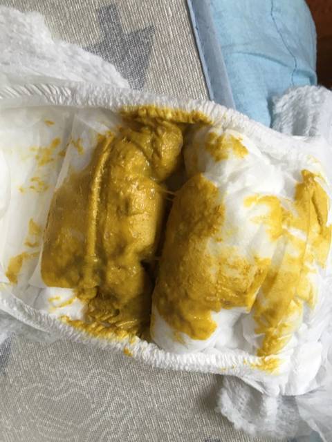 宝宝这种大便正常吗