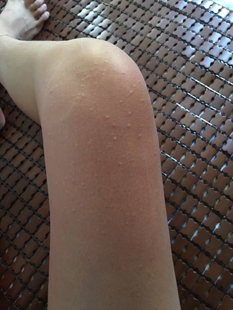 难受_怀孕期间得了荨麻疹怎么办 痒死了