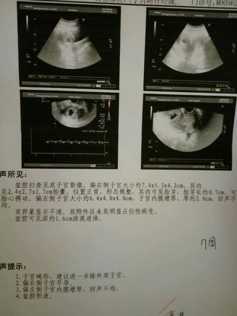双子宫_今天去医院做彩超,医生说我是双子宫,目前一切