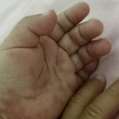 这是病毒性疱疹还是手口足?一岁宝宝发烧后就一直出疹子和泡,嘴巴里面也有,现在已经发展到整个下身都是了!老是挠耳朵里面,一挠耳朵就红了,而且耳朵发热_育儿问答_宝宝树