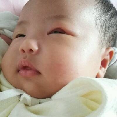 各位宝妈帮忙看看,宝眼睛肿了四天了,刚开始以