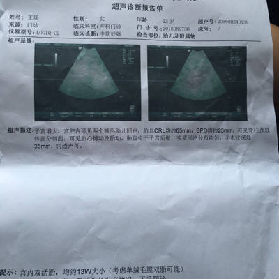 检查出来的报告是这样的,请问我怀的是同卵还