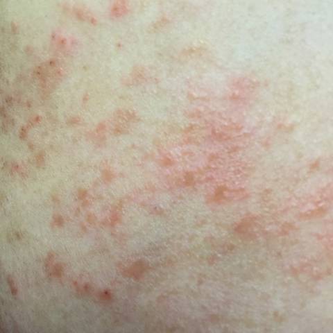 分享一下我与妊娠痒疹的斗争经验_首先声明下