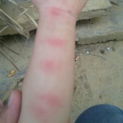 宝宝手上长了好多个大包,脸上也有。不像是蚊