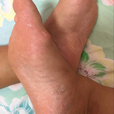 脚痒啊,十二点了还在抓,痒的难受