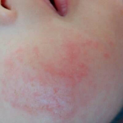 宝宝脸上长湿疹几天能好 宝宝过敏长湿疹多久能好