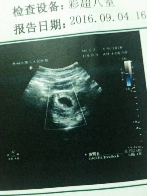 末次七月十八,有胎心胎芽了。_大半年前备孕一