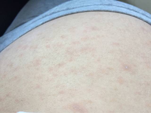 身上长痘了_我怀孕七个月了,身上痘痘长了快两