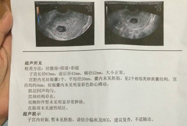 2个卵黄囊8周无胎心胎芽未见胚胎_按月经推算