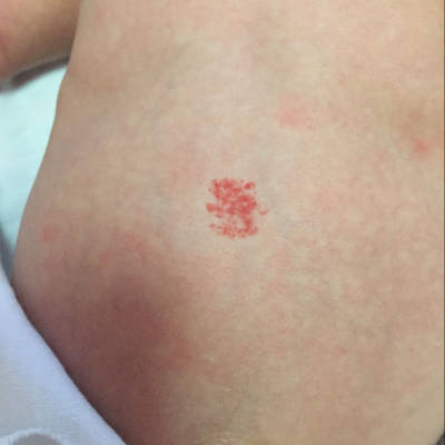 宝宝刚27天…腹部这个红斑是什么