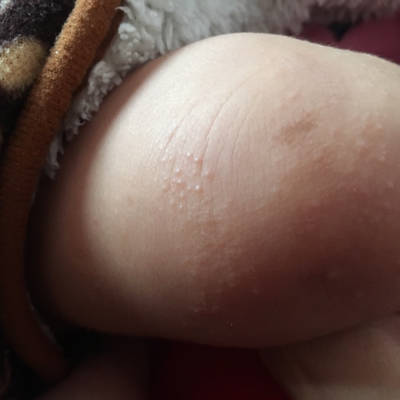 两个半月宝宝腿上 前手臂起了些这些小疙瘩 是什麼