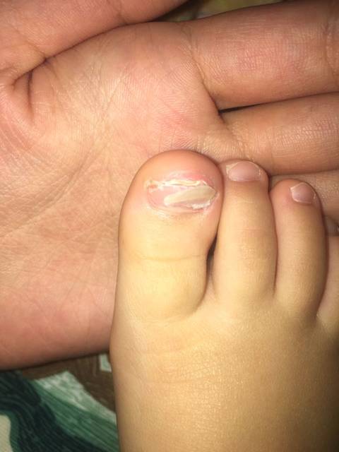 两岁宝宝,脚大拇指指甲分层"离骨"怎么回事