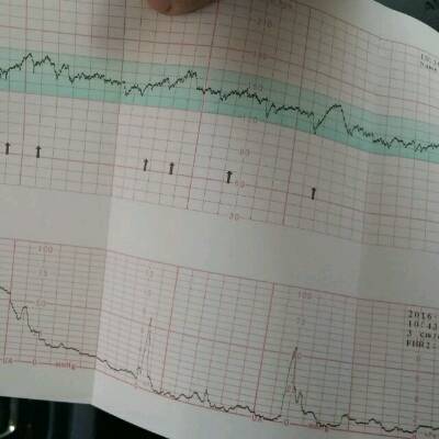 有哪位宝妈帮我看一下 胎心监测正常吗 为什下面的