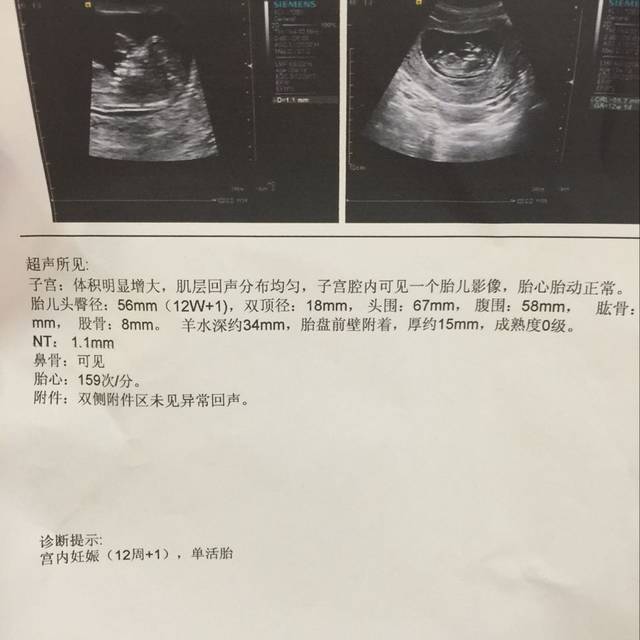 怀孕三个月 NT如何看胎儿性别_我这个能看出