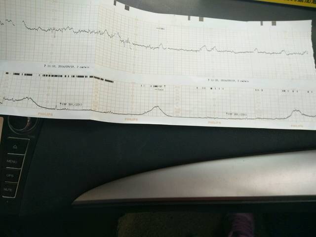 胎心监护的结果图,下排宫缩显示有3次,基本上是达到了40,需要住院待产