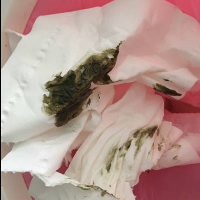 宝宝拉绿色的屎一个月了,没有任何症状 状态也很好,喝的氨基酸奶粉,请