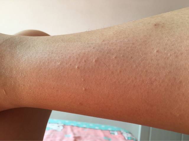 36周,大家帮忙看看_很痒,一挠就会出现大小不