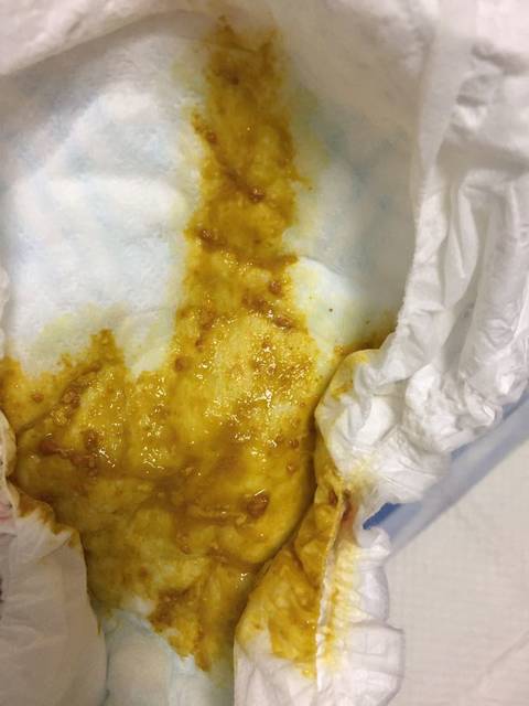 一个半月宝宝大便有橘色颗粒怎么回事(有图慎