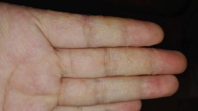 要奔溃了,求搭救!!!_最近脚上长了很多透明的水泡(真菌),_宝宝树