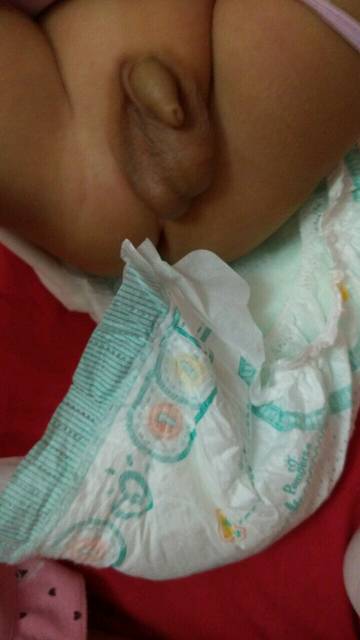 宝贝睾丸_宝贝睾丸一大一小正常吗