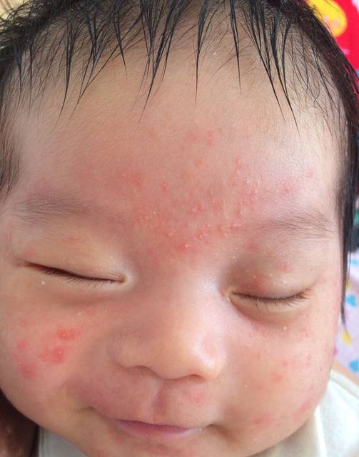 宝宝脸上长红点里面带白头_越来越多,是湿疹还