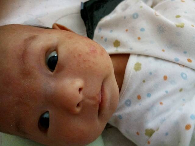湿疹治疗方法_我家宝宝现在两个月了,从出生1