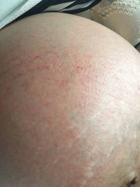 肚子痒,怎么办_肚子痒、一挠就变成这样了,怎