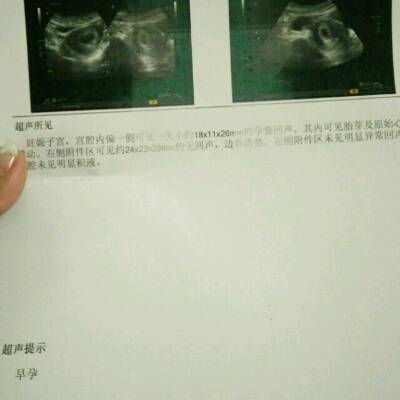 左腹疼怎么回事微疼