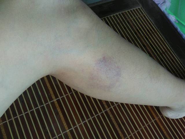 有没有宝妈这样的_孕27周小腿一直这样,又痛又