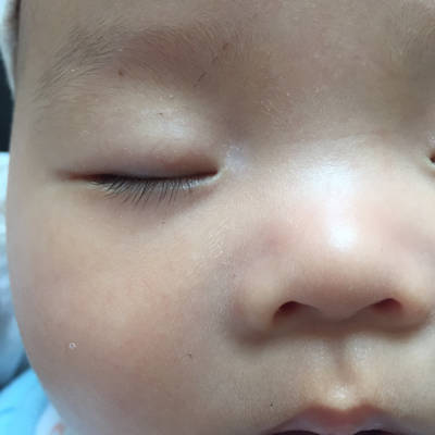 宝宝眼角长了块白色的,请问是什麼?