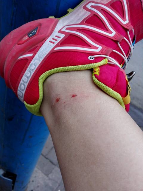 怀孕27周,昨晚被猫抓伤出血了,今天去打了狂犬