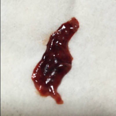 怀孕五周胎儿生化了,今天生化第四天也是来月