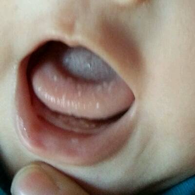 宝宝舌头和嘴巴上都长了这样的白点点,是檫不