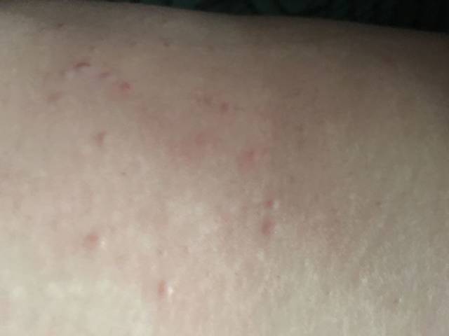 孕期痒疹_孕期痒疹,全身抓烂的节奏,谁有好办