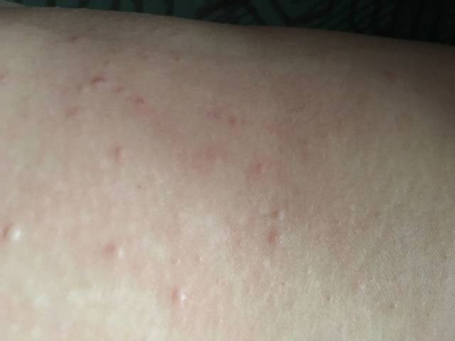 孕期痒疹_孕期痒疹,全身抓烂的节奏,谁有好办