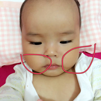 六个月宝宝脖子轻微歪,右边,而且脸不对称,是不