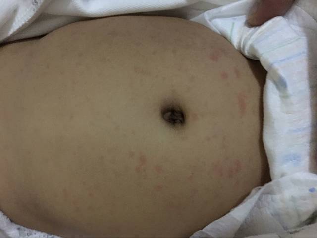 6个月宝宝一夜起了一身疹子宝妈快来帮忙看看