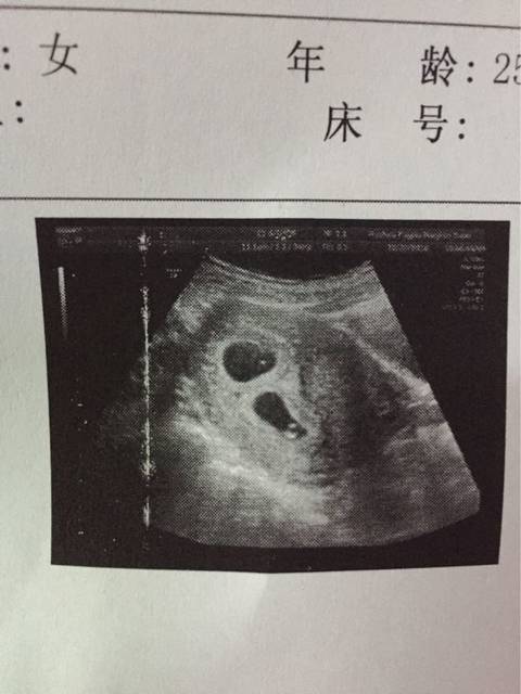 这是同卵双胎还是异卵双胎?求解_本周六刚做